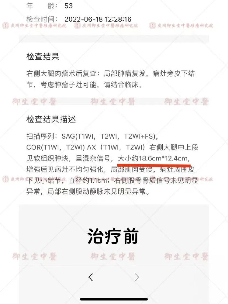 广州御和堂治疗肿瘤案例分析