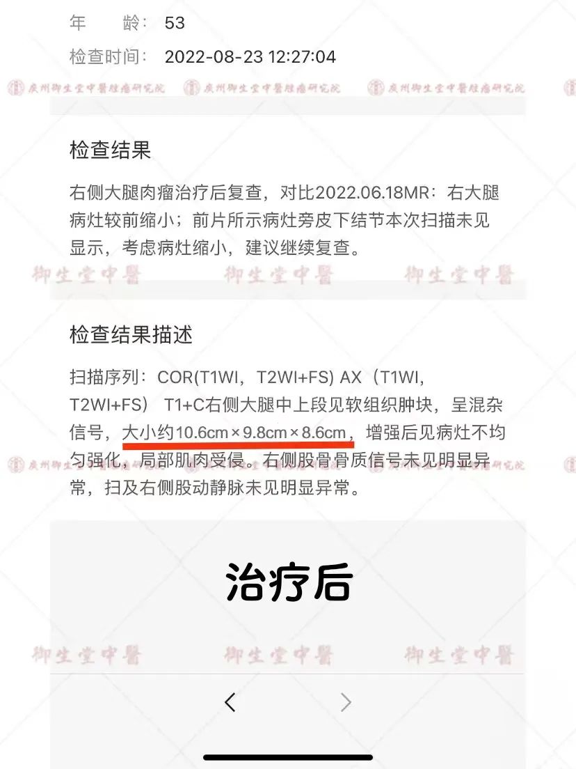 广州御和堂治疗肿瘤案例分析